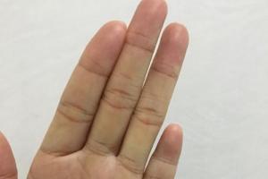 我的小拇指特别短特别奇怪究竟是为什么?